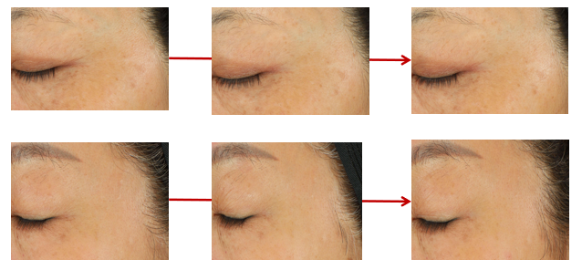 酵母β-葡聚糖能显著提高皮肤中丝聚蛋白