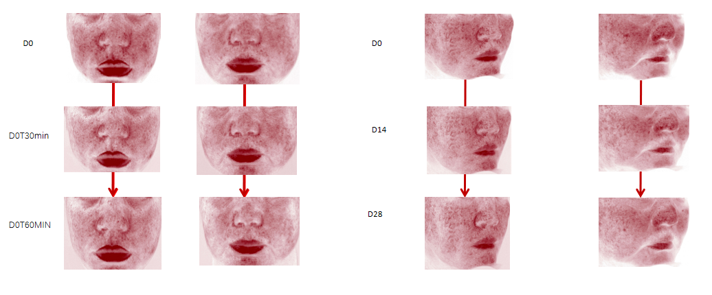 酵母β-葡聚糖可显著抑制皮肤中活性氧（ROS）的生成