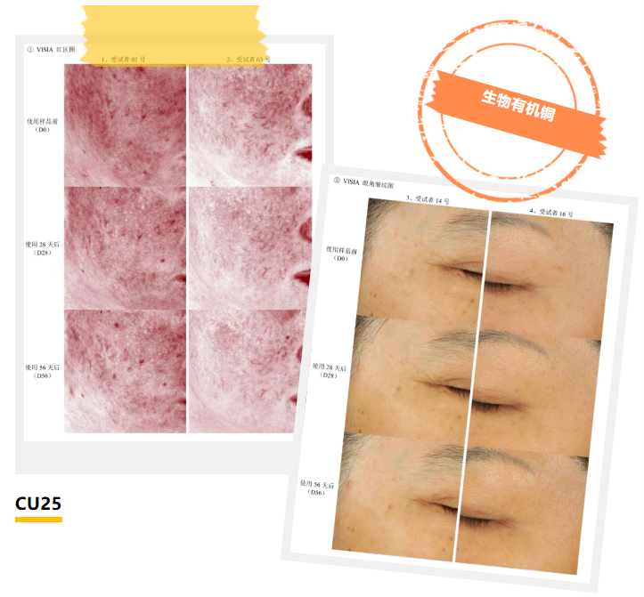 ，眼角及眼下皱纹面积均显著缩小